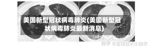 美国新型冠状病毒肺炎(美国新型冠状病毒肺炎最新消息)