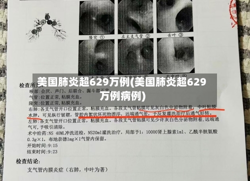 美国肺炎超629万例(美国肺炎超629万例病例)